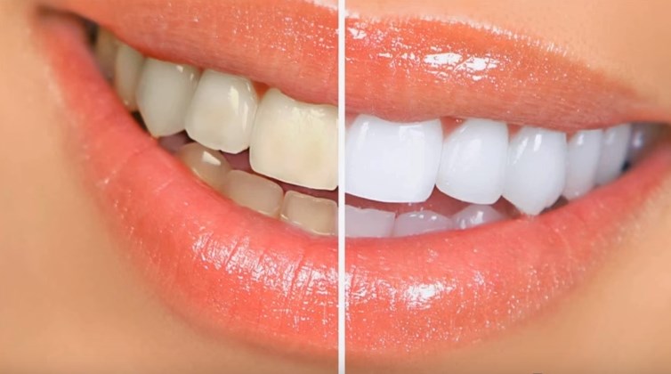 Los remedios caseros te ayudan a blanquear los dientes sin necesidad de recurrir a especialistas