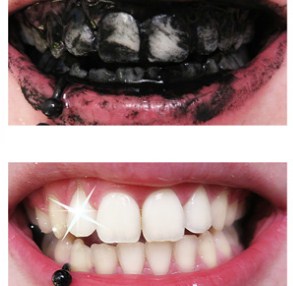 blanquear dientes con carbón activado deja la boca libre de gérmenes y bacterias causantes de enfermedades, elimina la placa dental y desmancha la dentadura de manera superficial