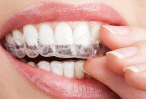 El procedimiento de blanquear los dientes en casa mediante férulas dentales, es muy sencillo