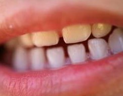 Los dientes amarillos en niños es una preocupación para los padres, pues encuentran que los dientes definitivos no son tan blancos como los temporales