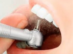 es necesario realizar una limpieza dental con ultrasonido cada 6 o 12 meses