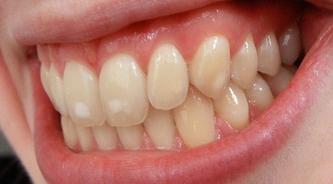 Las manchas blancas en los dientes suelen ser algo antiestético y su presencia es desagradable para muchos