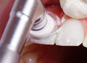 Consiste en remover la capa externa del diente a través de una abrasión débil para eliminar manchas blancas en los dientes
