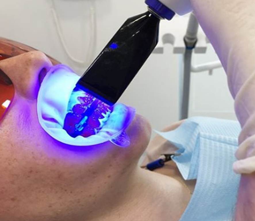 Blanqueamiento dental con luz LED